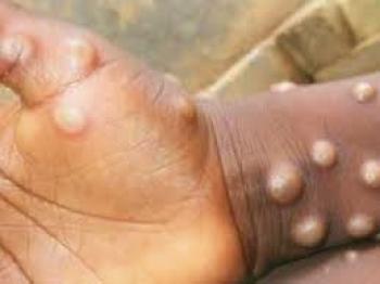 Amambay: Emiten alerta sanitaria por paciente con viruela símica